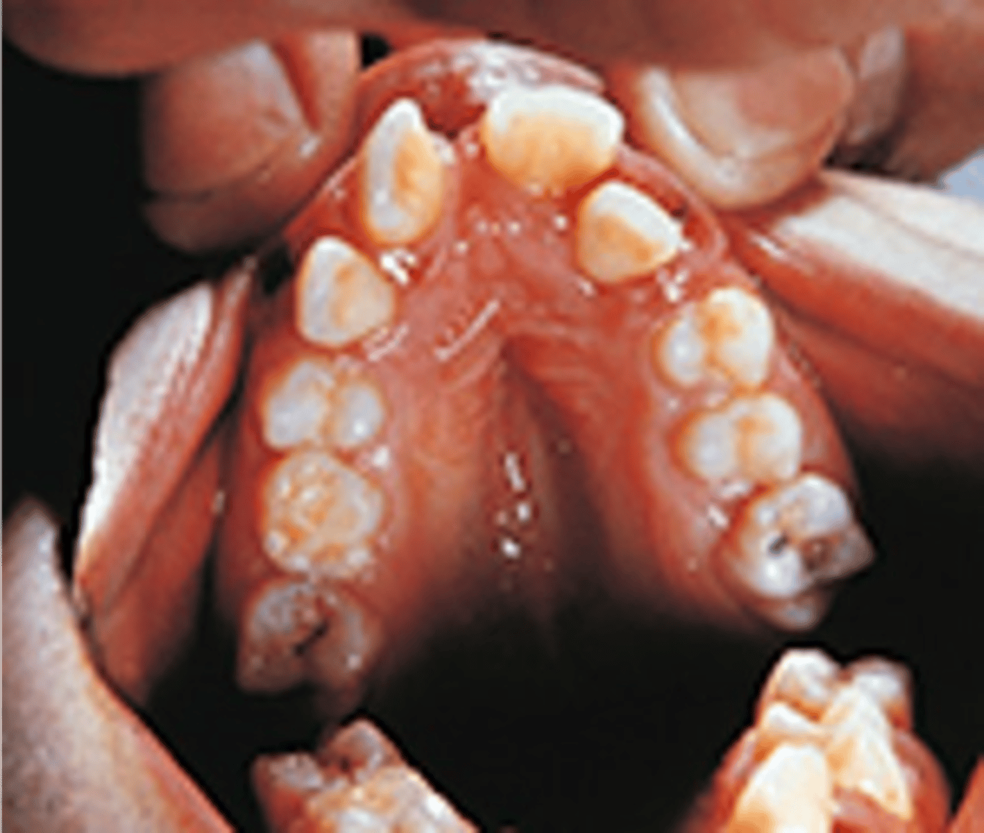 <p>Also called Treacher Collins Syndrome, it is a genetic disorder that affects the development of the facial structure. Characterized by a fish-like mouth (high palate, downward sloping of the lip commissures, and an open-bite). Deafness results from a lack of otic ossicles.</p>