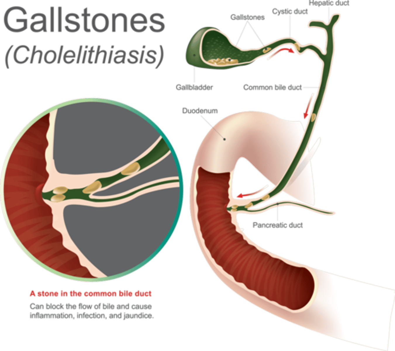 <p>Biliary obstruction ( gallstones)</p><p>Direct Toxicity ( alcohol)</p><p>Trauma/surgery/biliary procedures</p><p>drugs</p>