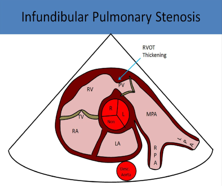 <p>tetralogy of fallot</p>