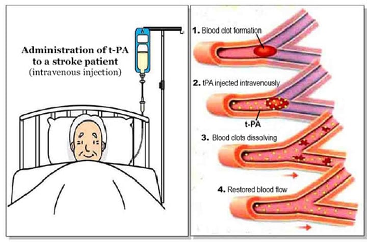 <p>tissue plasminogen activator; a fibrinolytic substance; a clot-dissolving drug</p>