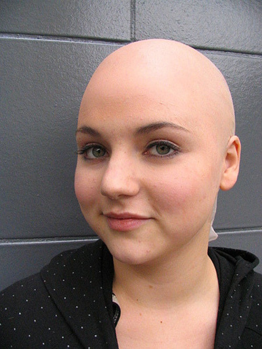 <p>total loss of terminal scalp hair</p>