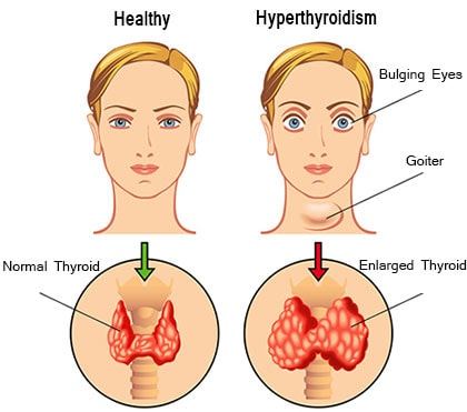 <ul><li><p>Overproduction of hormones produced in thyroid</p></li><li><p>Symptoms:</p><ul><li><p>enlarged thyroid</p></li><li><p>increased metabolism</p></li><li><p>unexpected weight loss</p></li><li><p>irregular or fast heartbeat</p></li><li><p>sweating</p></li><li><p>irritability</p></li><li><p>elderly may not show any symptoms</p></li></ul></li><li><p>can be caused by autoimmune disorders or malnutrition causing goiter</p></li></ul>