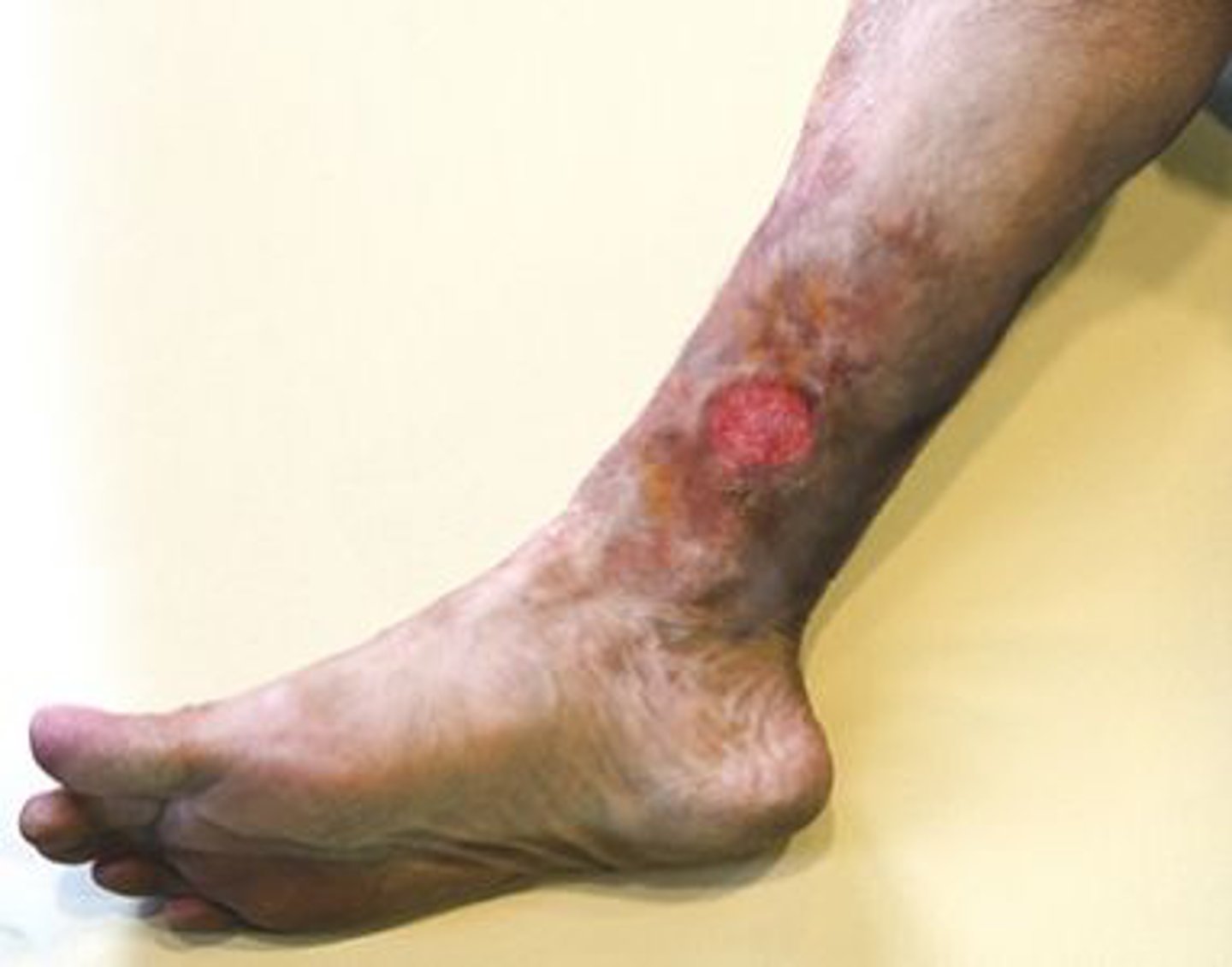 <p>The periwound pigmentation shown in the photograph is MOST likely to be associated with which of the following wound types?</p><p>1. Diabetic</p><p>2. Neuropathic</p><p>3. Venous insufficiency</p><p>4. Arterial insufficiency</p>