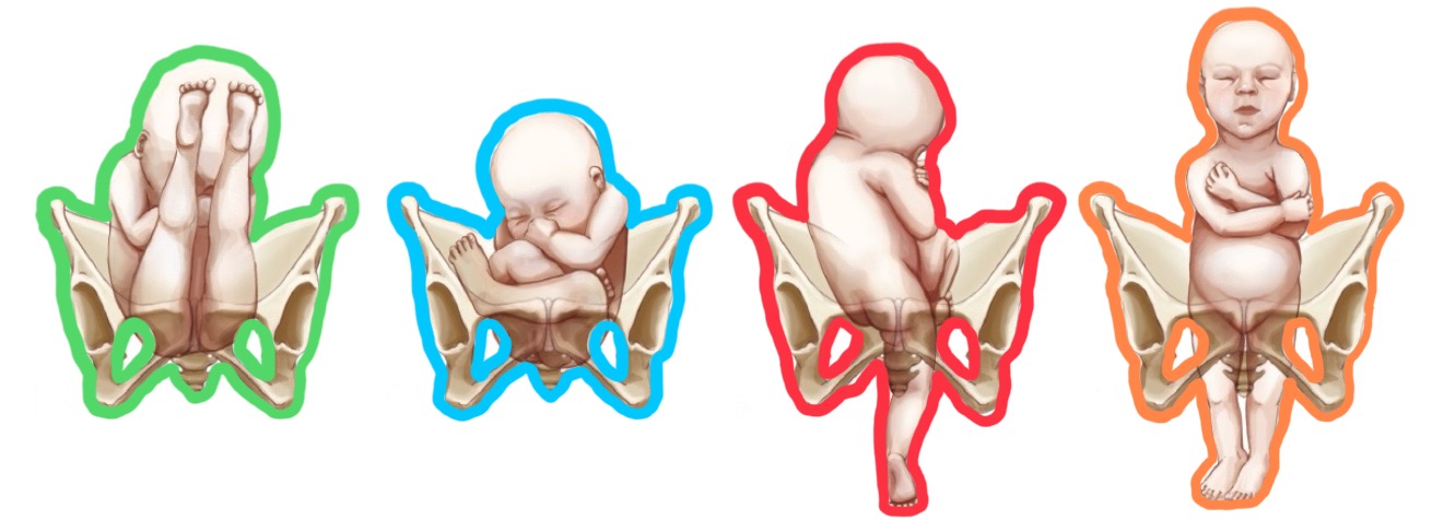 <p>orange breech presentation?</p>