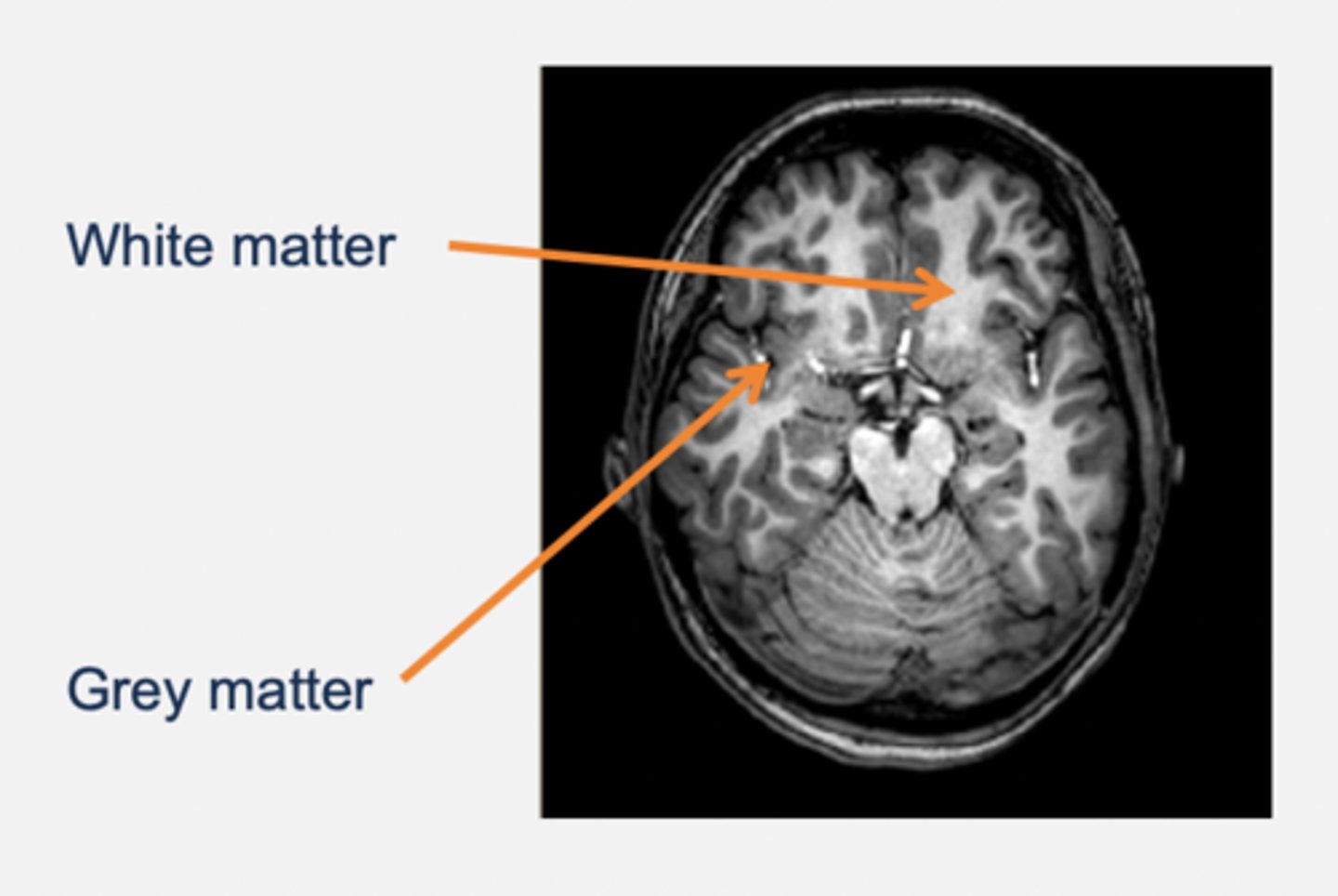 <p>Grey matter:</p><p>- Cell bodies and dendrites.</p><p>- E.g. cortex, basal ganglia, thalamus.</p><p>White matter:</p><p>- Myelinated axons.</p><p>- E.g. corpus callosum (a pathway that connects left and right side of hemisphere → commissure).</p>