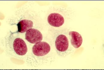<p>The image is a stained smear of cerebrospinal fluid. Which of the following statements is true about the cells shown at the right?</p><p></p><p>Their numbers are increased when the patient has leukemia.</p><p>Their numbers are increased when the patient has multiple sclerosis.</p><p>They line the arachnoid space.</p><p>They are capable of engulfing red cells.</p>