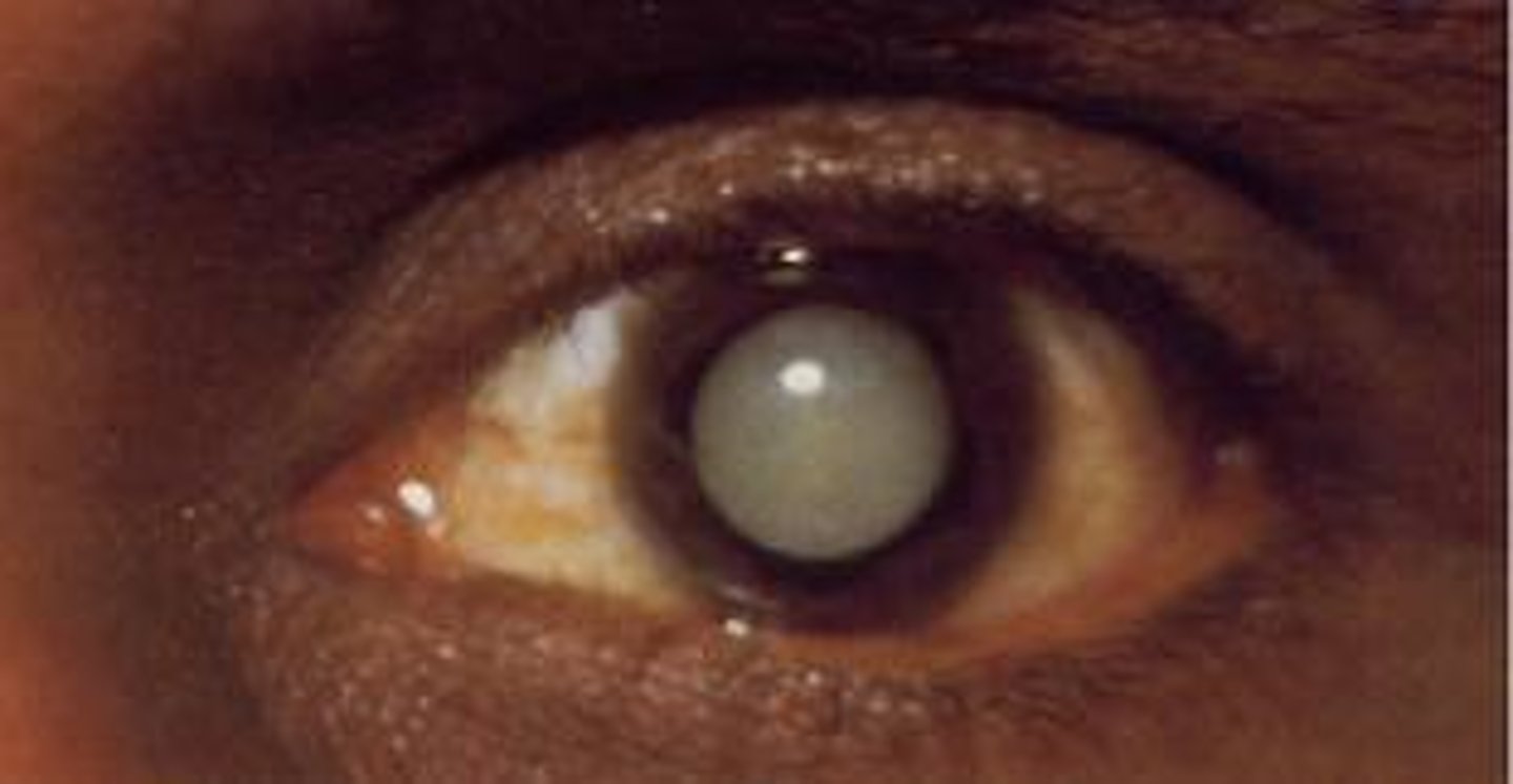 <p>a condition in which the lens of the eye becomes cloudy, causing vision loss</p>