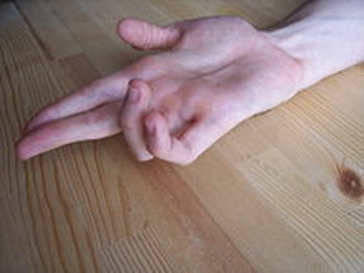 <p>weakness and atrophy of the hypothenar, interossei, and medial 2 lumbricals cause the medial fingers to assume a resting posture of flexion in the PIP and DIP joints. Extension of these joints are limited. ulnar nerve</p>