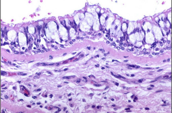 <p>exudate</p>