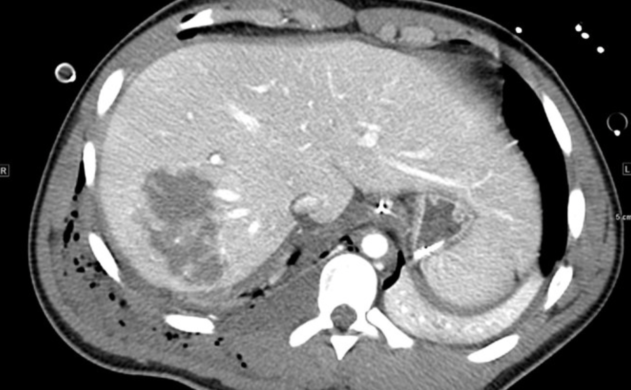 <p>What is CT showing?</p>