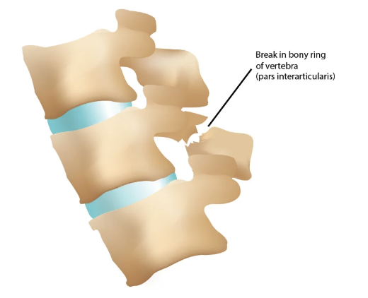 <p>A fracture through the pars interarticularis (weakest portion) that can occur on 1 or both sides of the bone (usually L4 or L5) </p>