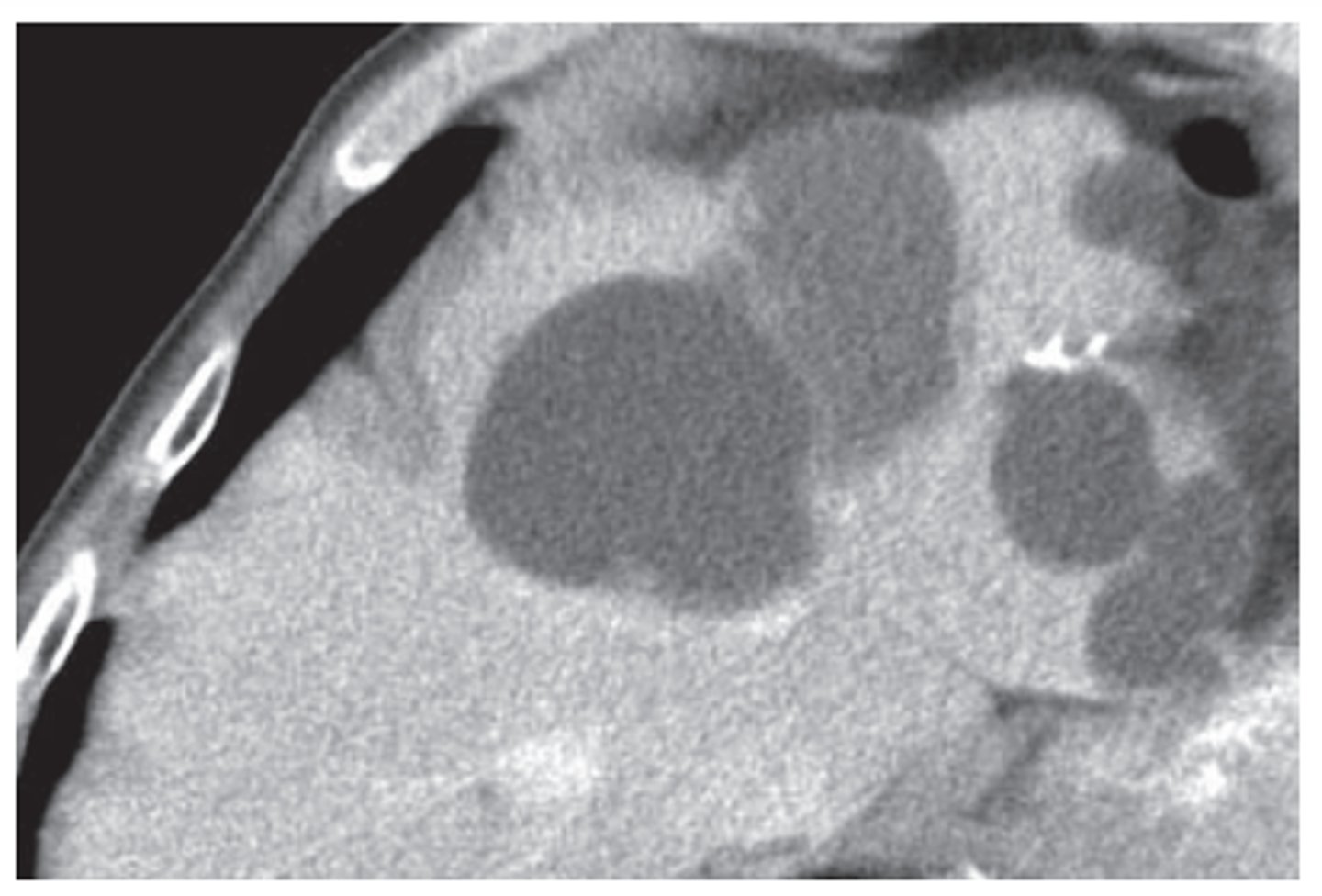 <p>common, usually incidental findings, lower density than liver, clearly defineed</p>