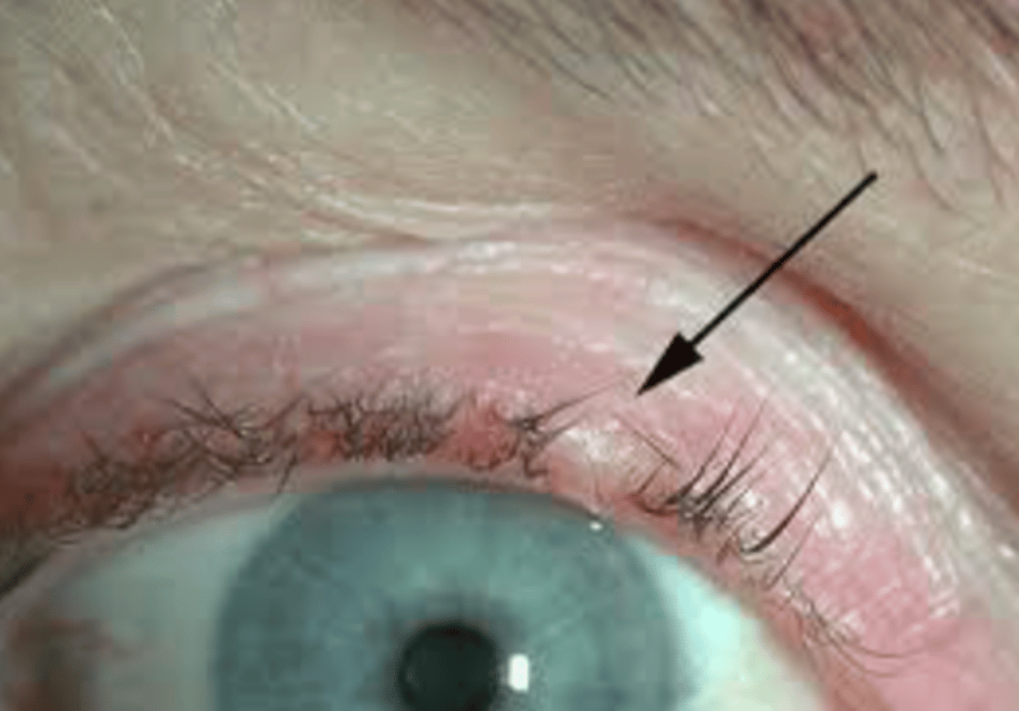 <p>Loss of eyelashes</p>