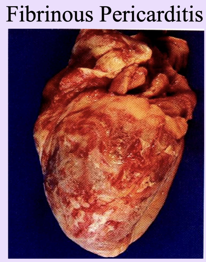 <p>Exudate rich in fibrin; can form shaggy layers on surfaces.</p><ul><li><p>seen in many bacterial infections (Strept throat)</p></li><li><p>Also in Fibrinis pericarditis</p></li></ul><p></p>