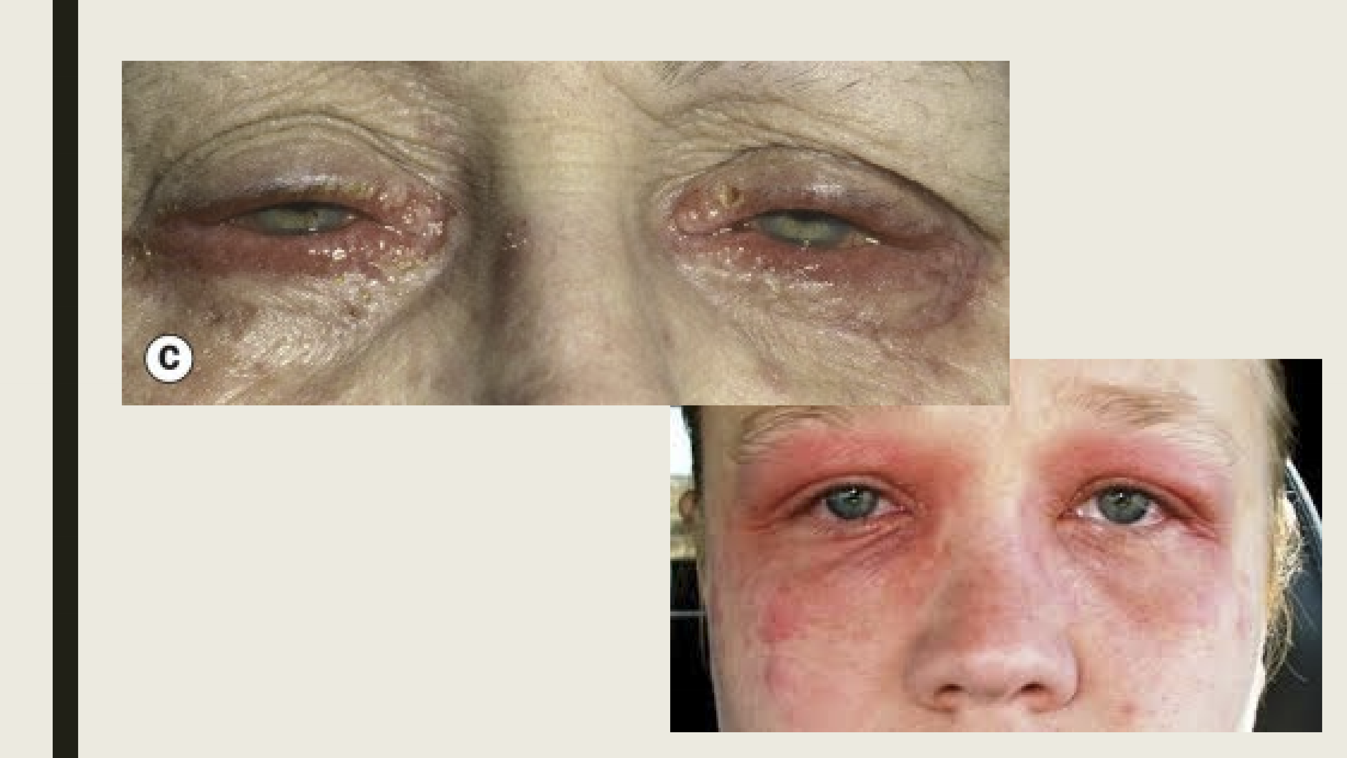 <p>Idiopathic conditions associated with asthma and hayfever. It is commonly seen in children with vernal disease. </p>