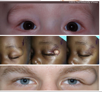 <ol><li><p>Smooth, subcutaneous mass<strong><u>, firm and not movable </u></strong>due to attachment to underlying periosteum</p></li><li><p>• Located <strong><u>superior-temporally at the site of the zygomaticofrontal suture</u></strong></p></li></ol><p></p>