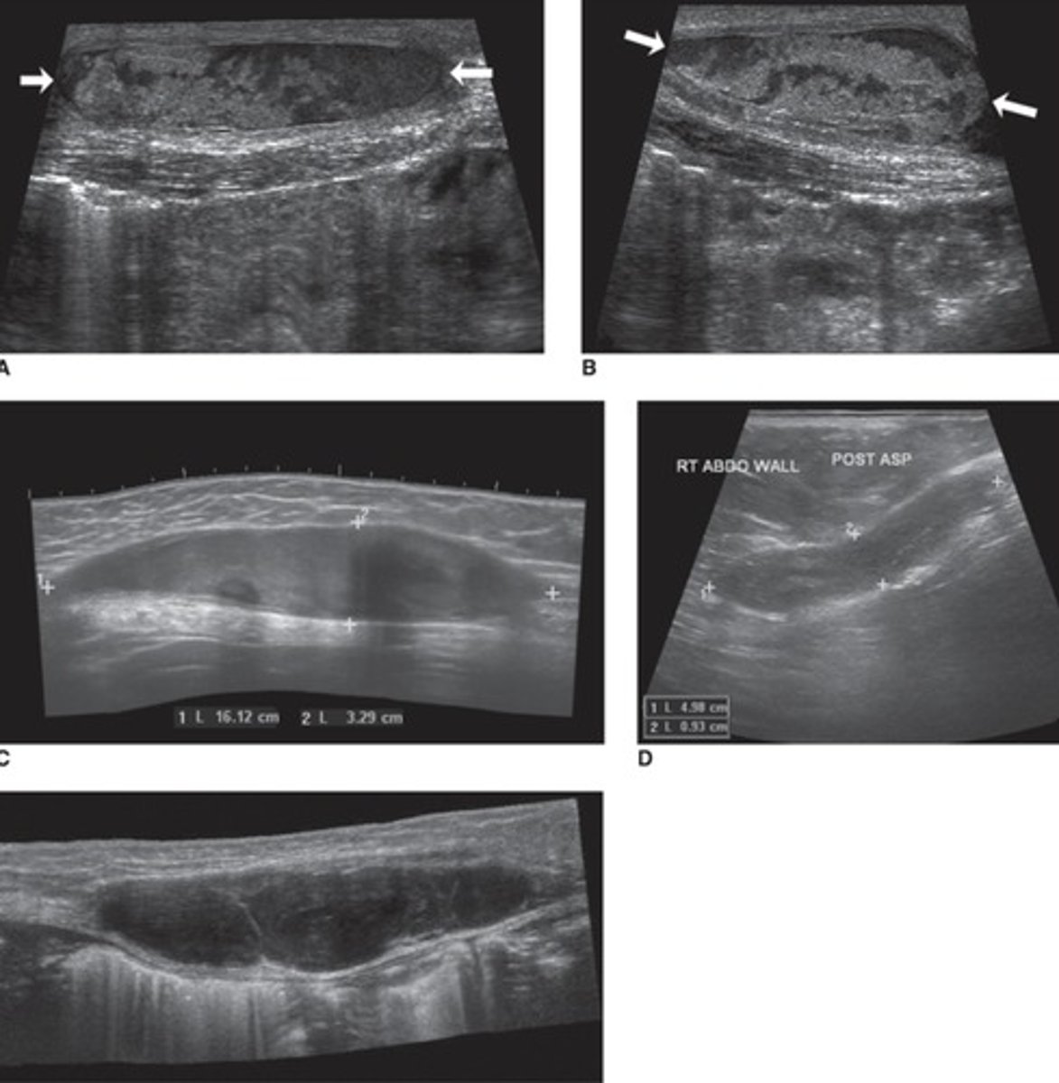 <p>Anechoic</p><p>Increased size and echogenicity</p><p>Solid, mid-level grey</p><p>Decreased size, complex</p><p>Seroma - cystic</p><p>Reabsorption and/or scar tissue</p>