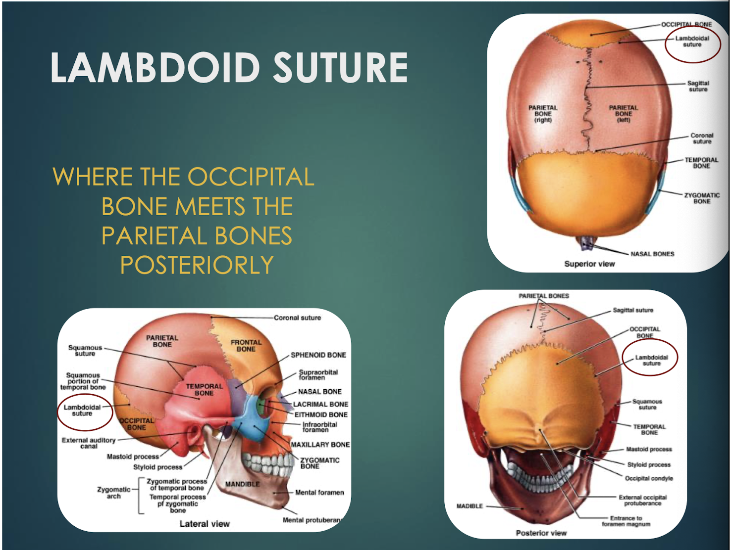 <p>Lambdoid Suture</p>