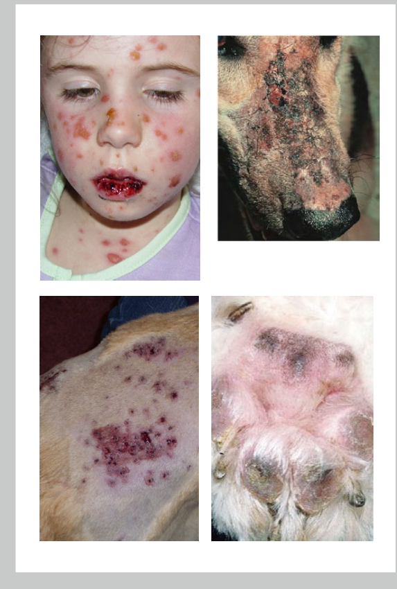 <p>why is CD95L so bad for stevens johnson syndrome</p>