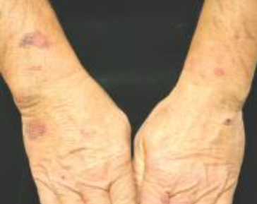 <p>ecchymosis to dorsal forearms and hands, doesn’t extend above “shirt sleeve” on upper arm</p>