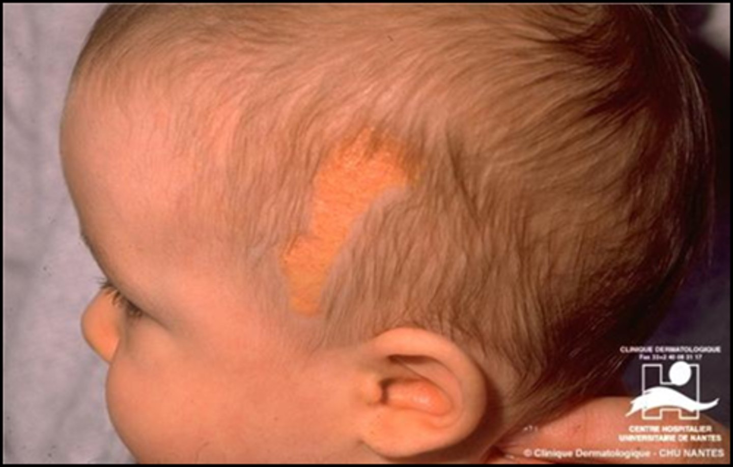 <p>"an area of alopecia with orange colored nodular skin"</p><p>Remove before adolescence b/c it can undergo malignant degeneration.</p>