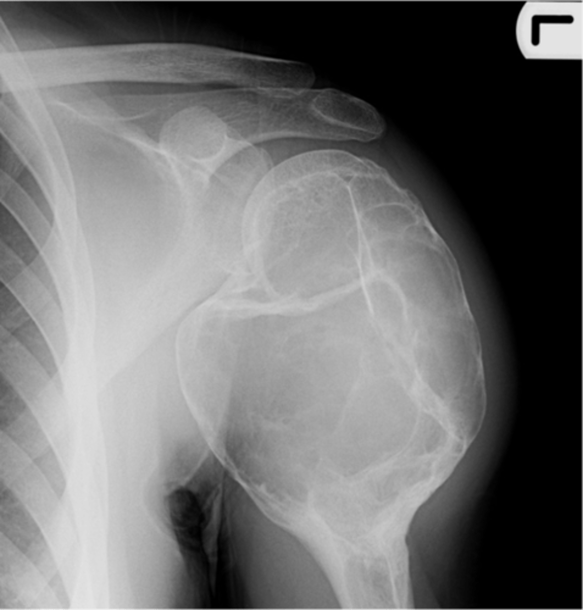 <p>State the radiographic features of aneurysmal bone cyst in tubular bones</p>