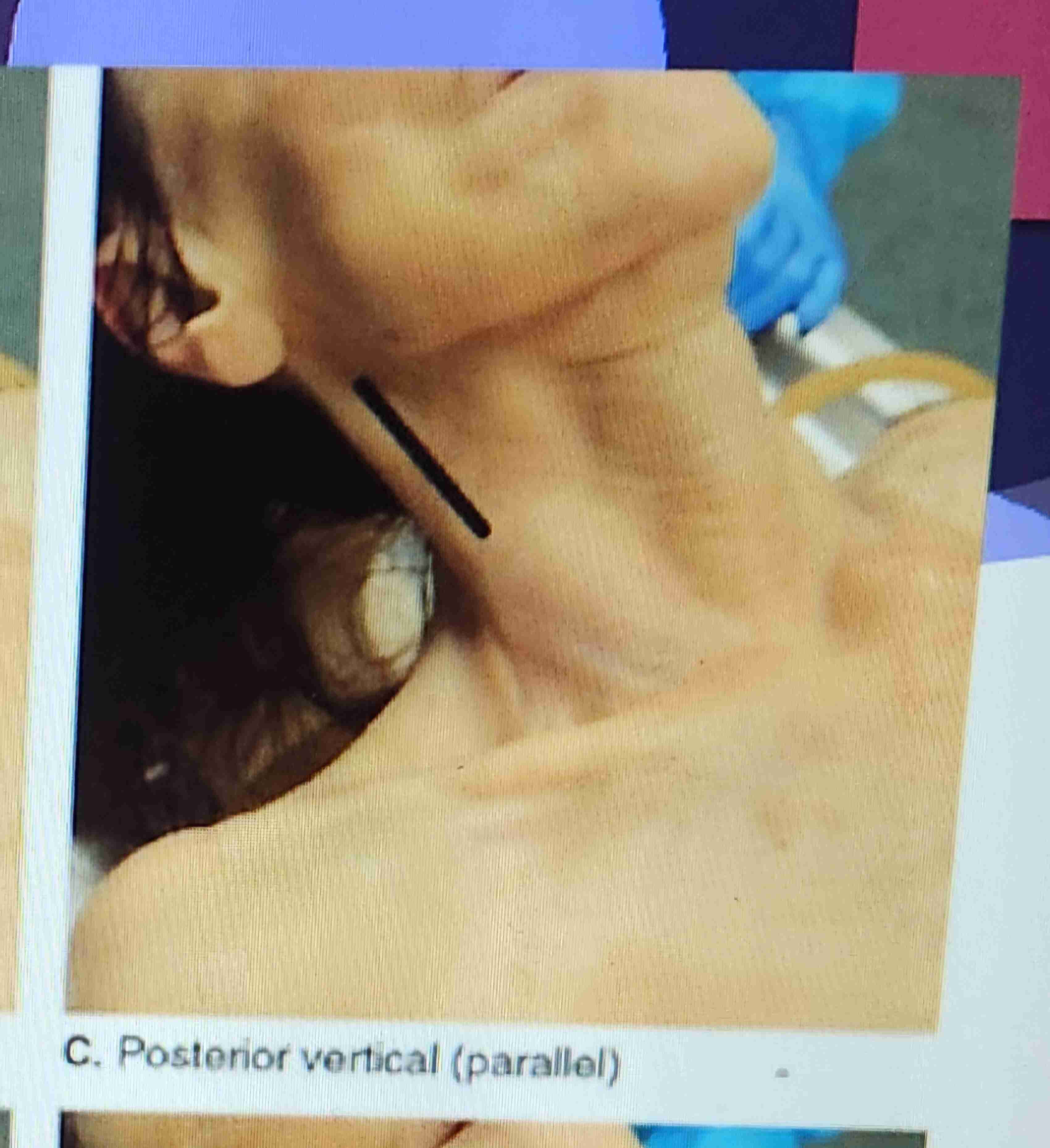 <p>Posterior Verticle (Parallel)</p>