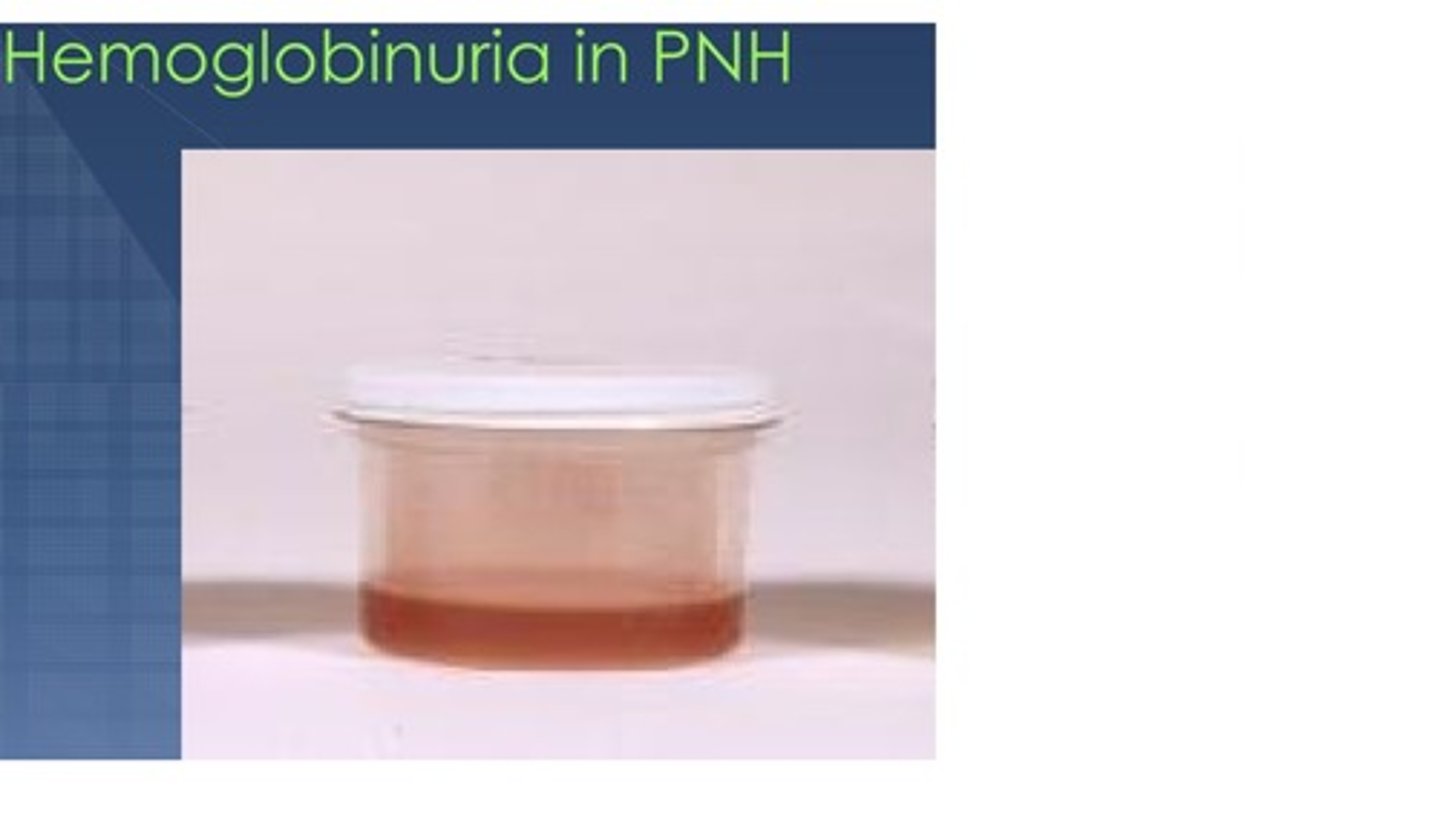 <p>Presence of free hemoglobin in the urine</p>
