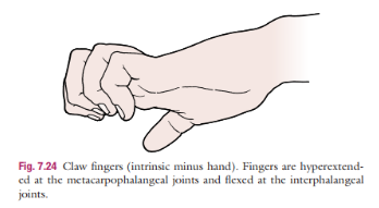 <p>Claw hand deformity</p>