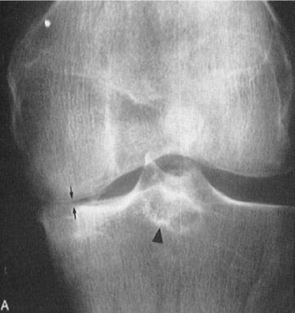 <p>With osteoarthrosis of the knee joint, the _____ tibiofemoral joint is more commonly affected</p>