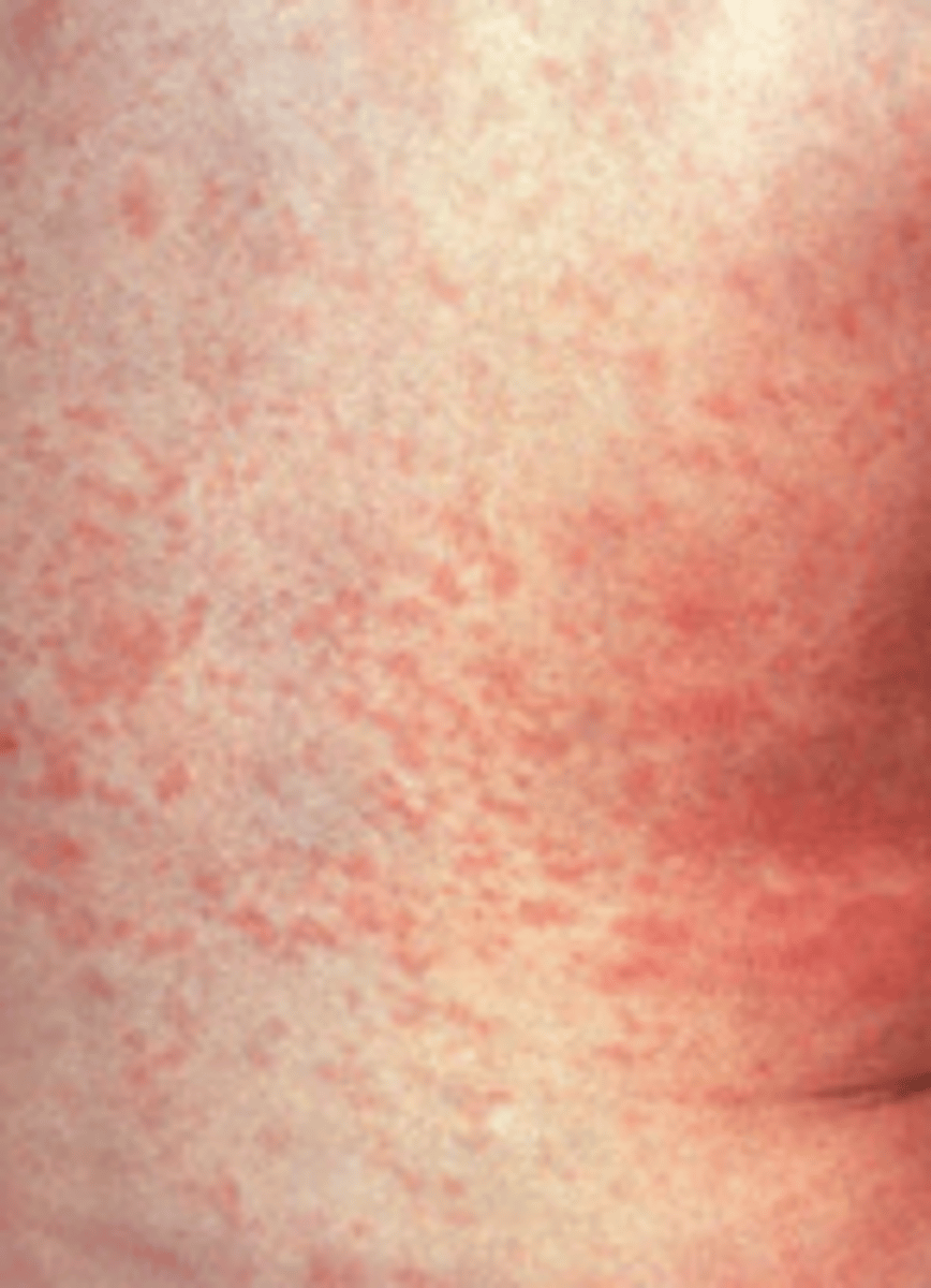 <p>prodrome then rash on face --&gt; trunk</p>