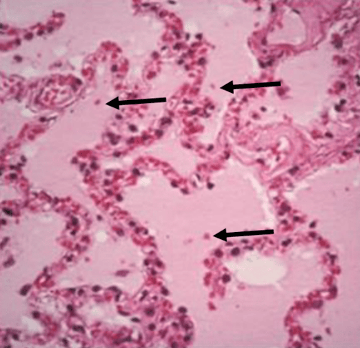 <p>what type of exudate is shown microscopically?</p>