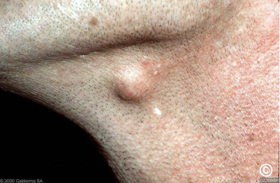 <p>A 35 year presented with cystic swelling on left side of the neck of 2 cm diameter. Provide DD</p>