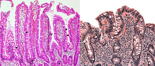 <p>villi flattened, damaged, or not present </p><p>disorder of the small intestine </p><p>gluten reacts with the lining of the small intestine, leading to an attack by the immune system and damage to the microvilli and villi</p><p>-if left untreated, can lead to malabsorption, anemia, bone disease, and rarely, cancer </p><p>treatment: avoid eating food with gluten</p><p>histological features: villous atrophy, inflammatory cells </p>