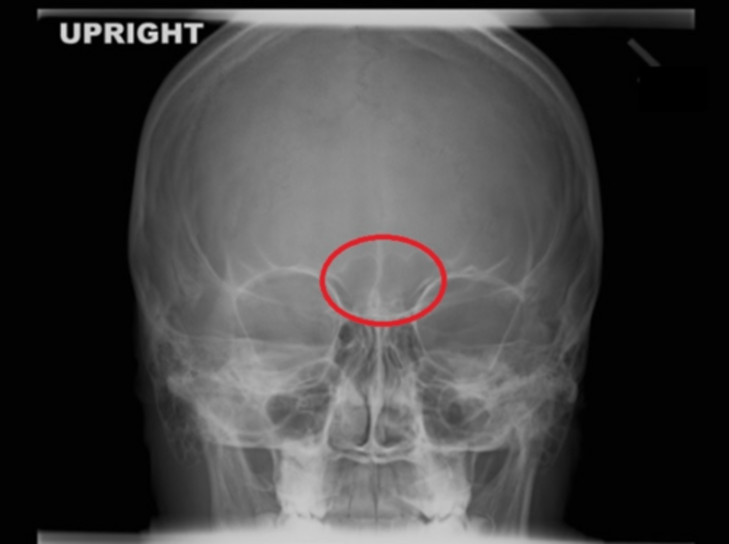 <p>which sinus group is within the red circle on this image?</p><p>a. ethmoidal</p><p>b. frontal</p><p>c. maxillary</p><p>d. sphenoidal</p>