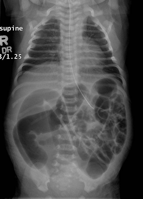 <p>How is imperforate anus classified?</p>