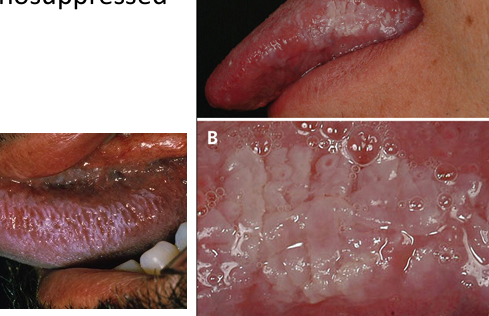 <p>-EBV-induced white plaque on the lateral tongue in immunosuppressed individuals- not exclusive to HIV+</p><p>-faint white vertical streaks, do not rub off</p><p>-thickened, furrowed, shaggy keratin</p>