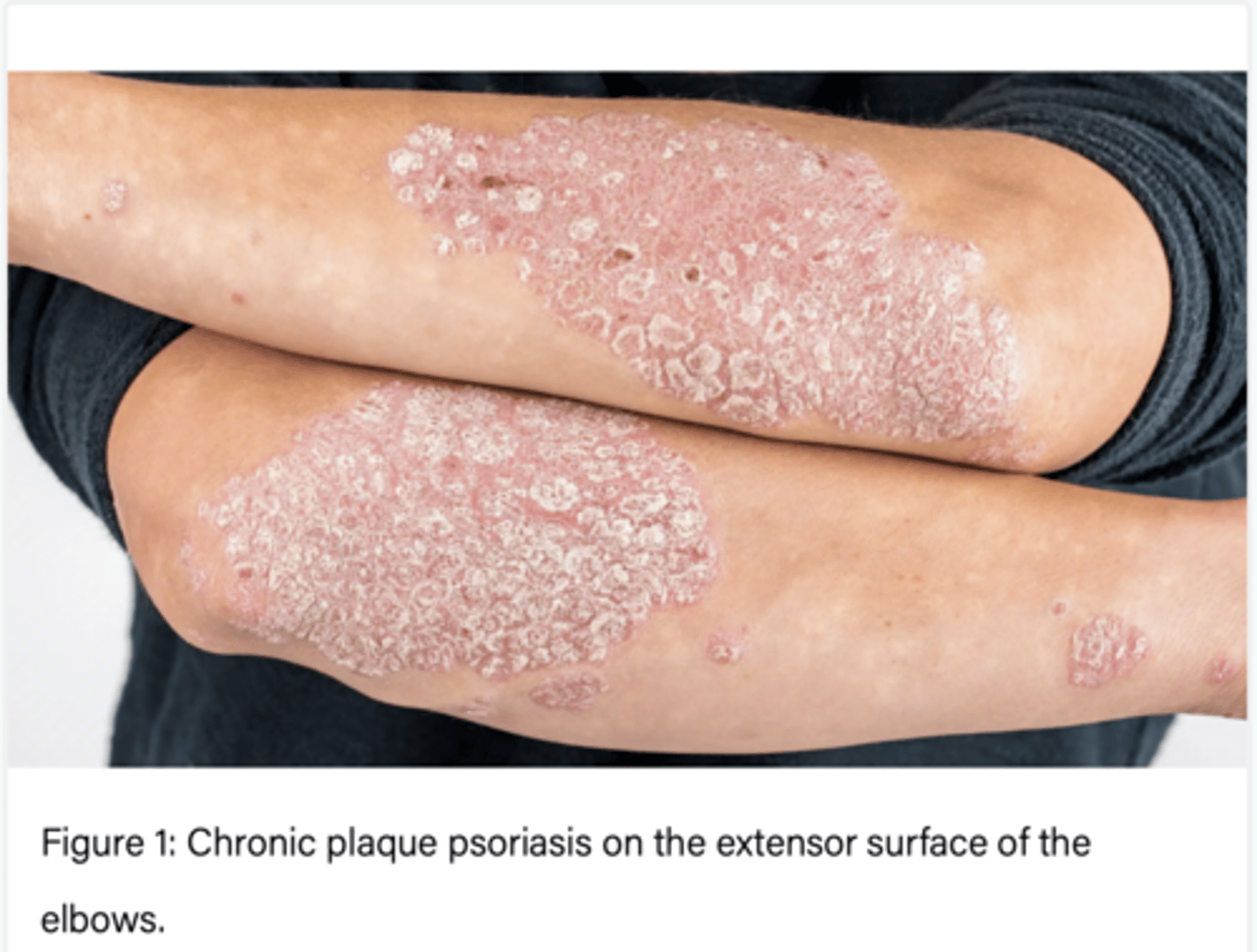 <p>Psoriasis is a chronic autoimmune disease characterised by well-demarcated, erythematous, scaly plaques.</p><p>characterised by inflammation (resulting in redness) and hyperproliferation of keratinocytes (resulting in scale).</p>
