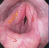 <ul><li><p><strong>Pharyngeal lymphoid hyperplasia</strong></p><ul><li><p><span style="color: rgb(136, 136, 136);"><strong>Et:</strong></span><strong> </strong><u>Normal in young horses, associated w/ immune dev</u></p></li><li><p><span style="color: rgb(136, 136, 136);"><strong>Cs:</strong> </span>sore throat/<u>cough</u>, <u>DDSP</u></p></li><li><p><span style="color: rgb(136, 136, 136);"><strong>Tx: </strong></span>rest, <u>soft feeds, NSAIDs/steroids, throat sprays&nbsp;</u></p></li></ul></li><li><p><strong>Laryngitis/chondritis</strong></p><ul><li><p><span style="color: rgb(136, 136, 136);"><strong>Et: </strong></span>Persistent <u>inflam</u>, high-speed work, hemiplegia, epiglottic entrapment, coarse feeds&nbsp;</p></li><li><p><span style="color: rgb(136, 136, 136);"><strong>Cs:</strong></span> <u>obx, insp noise, dysphagia, aspiration, stenosis,&nbsp; DDSP</u></p></li><li><p><span style="color: rgb(136, 136, 136);"><strong>Tx:</strong></span> <u>rest, NSAIDs, antibiotics, partial arytenoidectomy, tracheostomy&nbsp;</u></p><ul><li><p>Poor prognosis for performance</p></li></ul></li></ul></li><li><p><strong>Pharyngeal cicatrix: </strong>Idiopathic inflam scarring, <u>Texas pasture horses&nbsp;</u></p></li></ul><img src="https://knowt-user-attachments.s3.amazonaws.com/a470c386-a2d1-478f-9256-94ed458c865d.png" data-width="25%" data-align="center"><ul><li><p><strong>Pharyngeal neuropathies: </strong><u>GP disease (mycosis), trauma, EPM, encephalopathy, toxins (lead, botulism), myopathies (HYPP, white muscle dz)</u></p></li></ul><p></p>