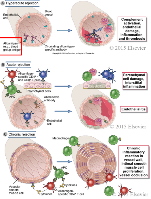 <p><span><span>In hyperacute rejection, preformed antibodies reactive with vascular endothelium activate complement and trigger rapid intravascular thrombosis and necrosis of the vessel wall. </span></span></p><p><span><span>In acute rejection, CD4+ and CD8+ T lymphocytes reactive with alloantigens on endothelial cells and parenchymal cells mediate damage to these cell types. Alloreactive antibodies formed after engraftment may also contribute to parenchymal and vascular injury. </span></span></p><p><span><span>In chronic rejection with graft arteriosclerosis, injury to the vessel wall leads to intimal smooth muscle cell proliferation and luminal occlusion. This lesion may be caused by a chronic inflammatory reaction to alloantigens in the vessel wall.</span></span></p>