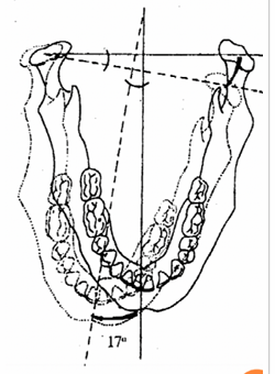 <ul><li><p>During the transversal movements of the mandible the incisal point outlines two segments left and right. </p></li><li><p>The angle formed between these segments is called Gothic and is about 120°.</p></li></ul><p></p>
