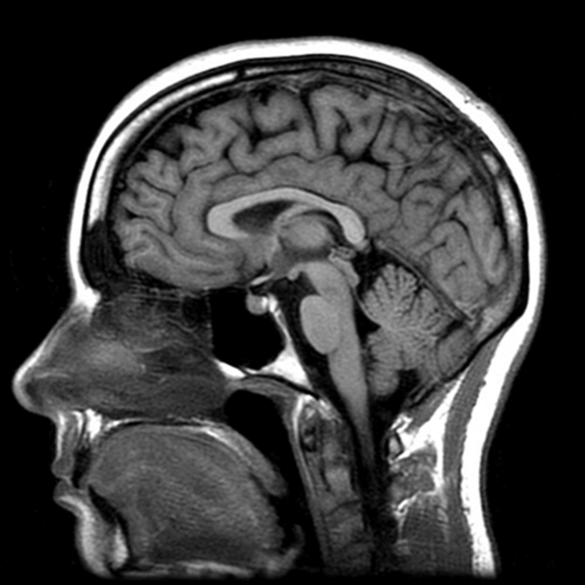 <p>- Excellent resolution of all soft tissue</p><p>- No ionizing radiation</p><p>- Sensitive to detect change in bone marrow-tumor, stress fracture, avascular necrosis</p>