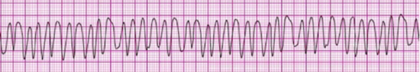 <p>Give an immediate unsynchronized high-energy shock (defibrillation dose)</p>