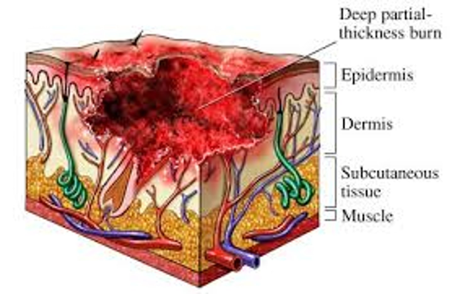 <p>epidermis/dermis; mixed red and waxy white areas, blanches to pressure with slow capillary refill, decreased pinprick sensation, pain on deep pressure; can take up to 3 weeks to heal, large wounds can be managed surgically. Development of hypertrophic and keloid scars is common.</p>