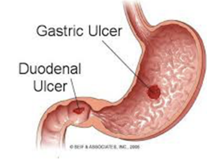 <ul><li><p>Involve mucosal lining of stomach/duodenum (first layer of inner lining)</p><ul><li><p>In chronic condition can reach submucosal layer &amp; sometimes even serosa </p></li></ul></li><li><p>Commonst cause — Helicobacter Pylori infection, but also due to gastric acid overproduction </p></li></ul><p>Duodenal ulcers can either be anterior or posterior</p><ul><li><p>Posterior duodenal ulcers — </p><ul><li><p>Erode either directly onto gastroduodenal artery or, more commonly, onto posterior pancreaticoduodenal artery (can produce torrential hemorrhage — can be fatal) </p></li><li><p>Treatment — extensive upper abdominal surgery with ligation of vessels or endovascular means (radiologist places very fine catheter retrogradely from femoral artery into celiac artery</p><ul><li><p>Common hepatic &amp; gastroduodenal artery are cannulated &amp; bleeding area may be blocked using small coils, stemming blood flow </p></li></ul></li></ul></li><li><p>Anterior duodenal ulcurs —</p><ul><li><p>Erode into peritoneal cavity, causing perionitis — this intense inflammatory reaction along with local ileus promote ahesion of the greater omentum, which attempts to seal off the perforation </p></li><li><p>Stomach &amp; duodenum usually contain gas, which will enter the peritoneal cavity (can be observed on chest radiograph of an erect patient as subdiaphragmatic gas) </p></li><li><p>In most instances, treatment is surgical</p></li></ul></li></ul>