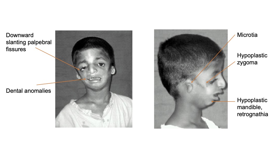 <p>What is first arch syndrome</p>