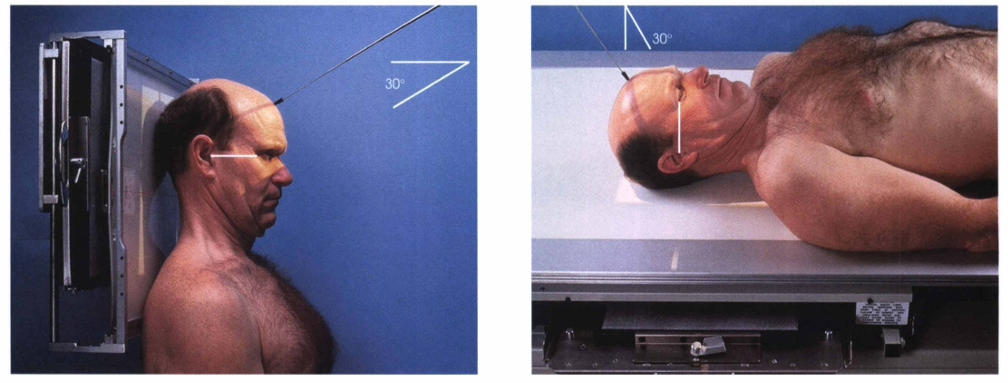 <p><span style="color: oklch(0.3039 0.04 213.68);">The central ray for the Towne method is directed through the ______________ at a caudal angle of ______________ degrees to the OML or ______________ degrees to the IOML.</span></p>