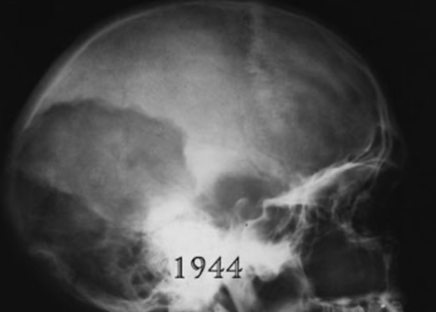 <p>Cotton woll appearance = appositional bone growth</p>