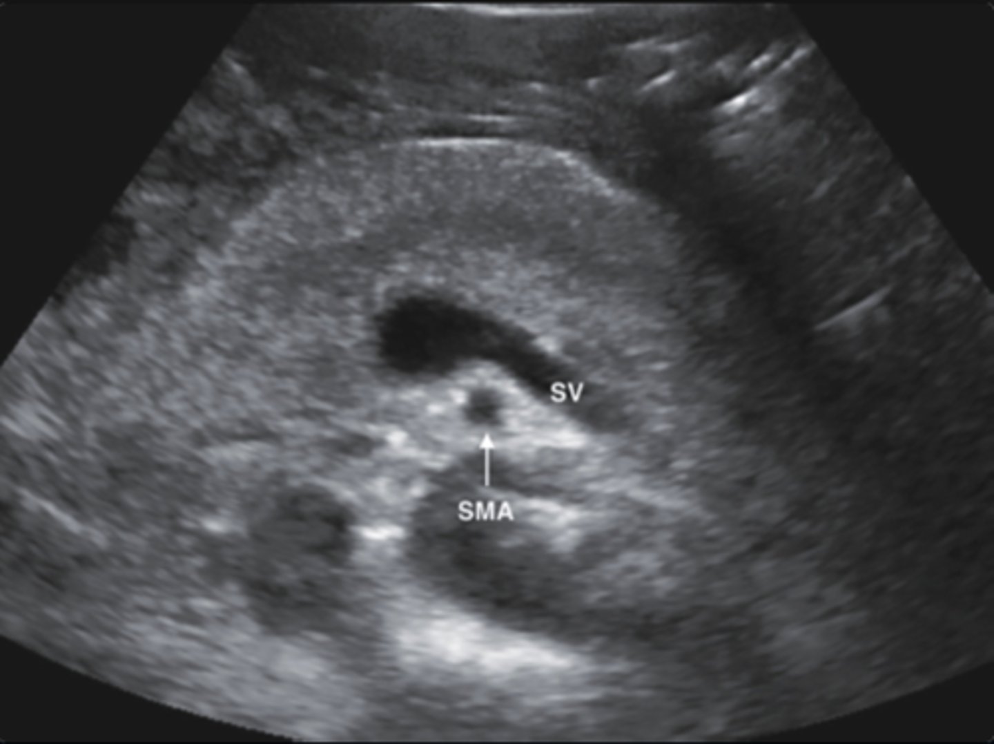 <p>b. Acute pancreatitis</p>