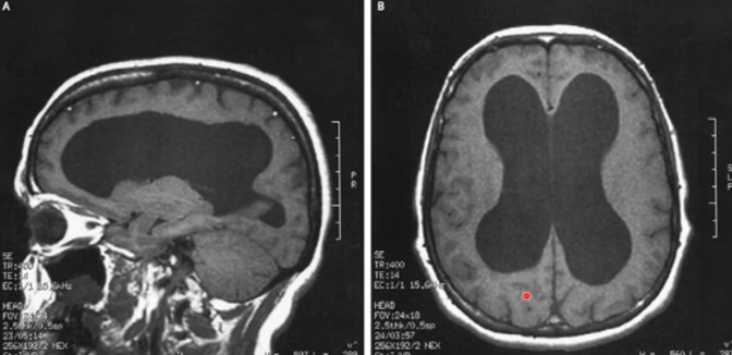 <p>enlargement of ventricles due to increase in volume of CSF</p><p>caused by CSF flow obstruction/impaired absorption</p><p>causes CSF to permeate through ependymal lining into periventricular white matter→raised ICP, white matter damage, gliotic scarring, CSF absorption via periventricular blood vessels</p>